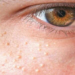 Puçrrat e vogla afër syve tregojnë për shëndetin tuaj