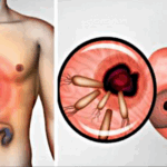 Vetëm kështu mund të largohet helikobakteri nga trupi