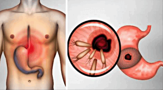 Vetëm kështu mund të largohet helikobakteri nga trupi