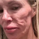 Ish-modelja tregon si i shpërthyen implantet e gjoksit dhe i shpërfytyruan fytyrën: U plaka 20 vite brenda natës